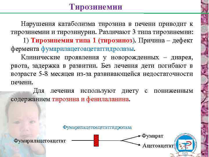 Тирозинемии Нарушения катаболизма тирозина в печени приводит к тирозинемии и тирозинурии. Различают 3 типа