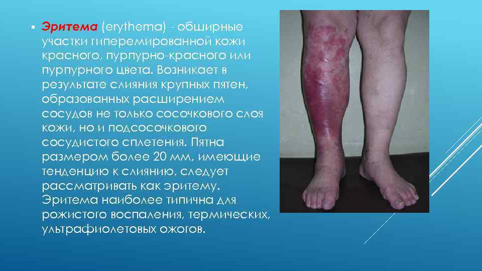 § Эритема (erythema) - обширные участки гиперемированной кожи красного, пурпурно-красного или пурпурного цвета. Возникает