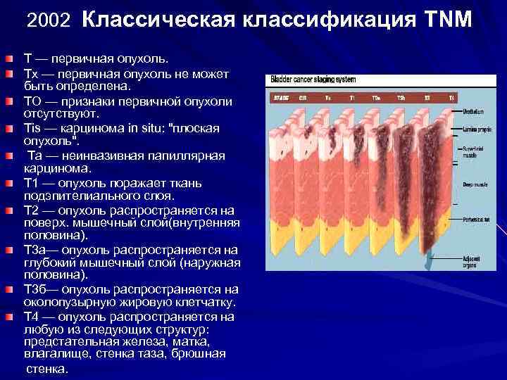 2002 Классическая классификация TNM Т — первичная опухоль. Тх — первичная опухоль не может