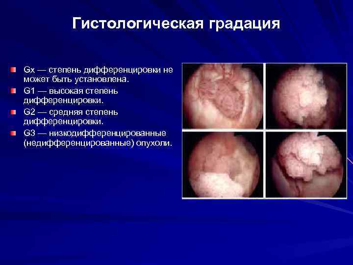 Гистологическая градация Gx — степень дифференцировки не может быть установлена. G 1 — высокая