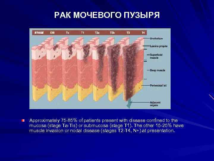 РАК МОЧЕВОГО ПУЗЫРЯ Approximately 75 -85% of patients present with disease confined to the