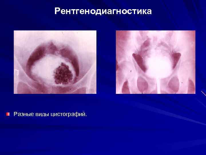 Рентгенодиагностика Разные виды цистографий. 