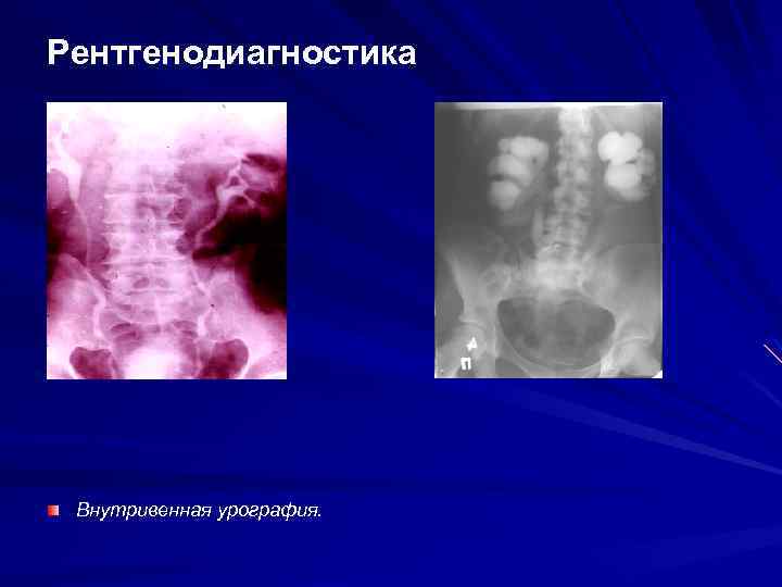 Рентгенодиагностика Внутривенная урография. 