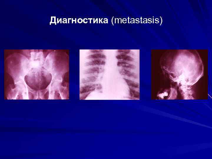 Диагностика (metastasis) 