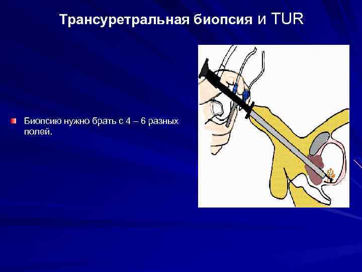 Трансуретральная биопсия и TUR Биопсию нужно брать с 4 – 6 разных полей. 