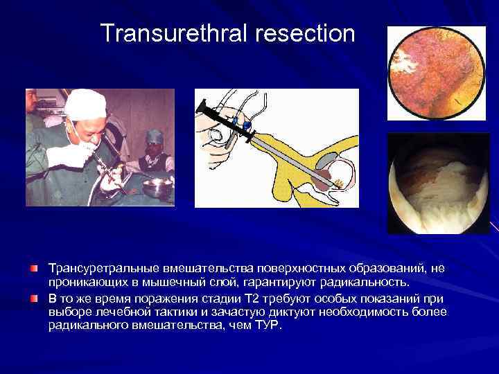 Transurethral resection Трансуретральные вмешательства поверхностных образований, не проникающих в мышечный слой, гарантируют радикальность. В