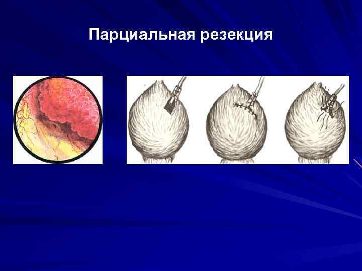 Парциальная резекция 