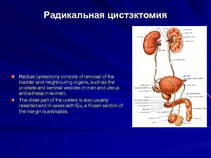 Радикальная цистэктомия Radical cystectomy consists of removal of the bladder and neighbouring organs, such