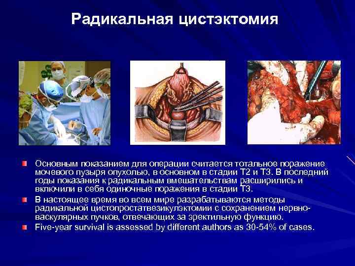 Радикальная цистэктомия Основным показанием для операции считается тотальное поражение мочевого пузыря опухолью, в основном