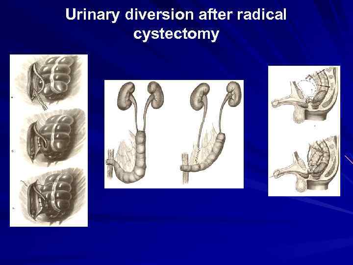 Urinary diversion after radical cystectomy 