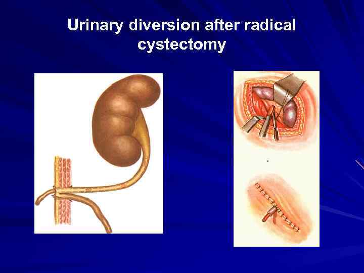 Urinary diversion after radical cystectomy 