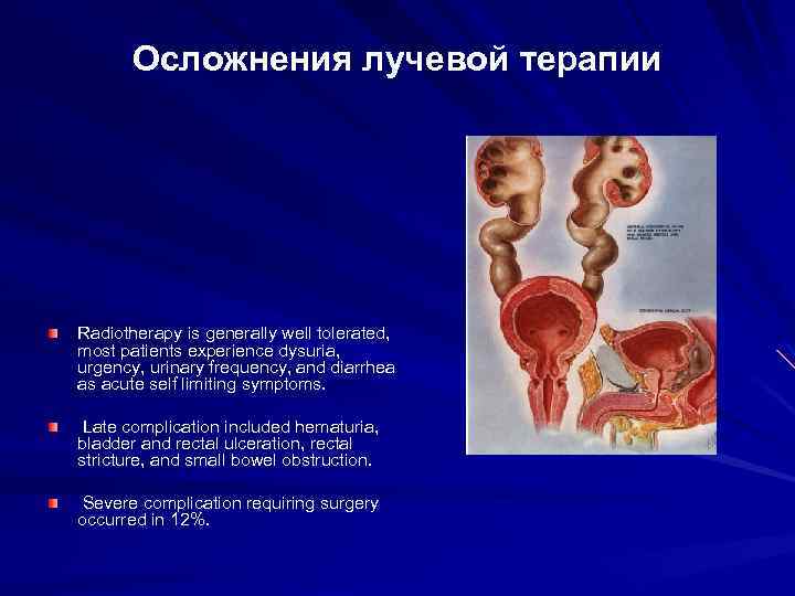 Осложнения лучевой терапии Radiotherapy is generally well tolerated, most patients experience dysuria, urgency, urinary