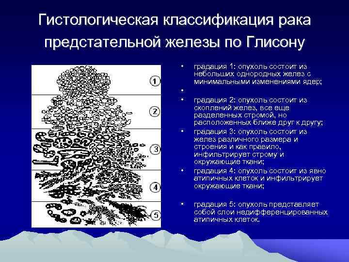 Гистологическая классификация рака предстательной железы по Глисону • • • градация 1: опухоль состоит