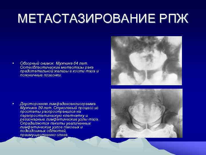 МЕТАСТАЗИРОВАНИЕ РПЖ • Обзорный снимок. Мужчина 64 лет. Остеобластические метастазы рака предстательной железы в