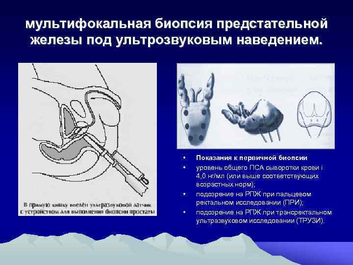 мультифокальная биопсия предстательной железы под ультрозвуковым наведением. • • Показания к первичной биопсии уровень