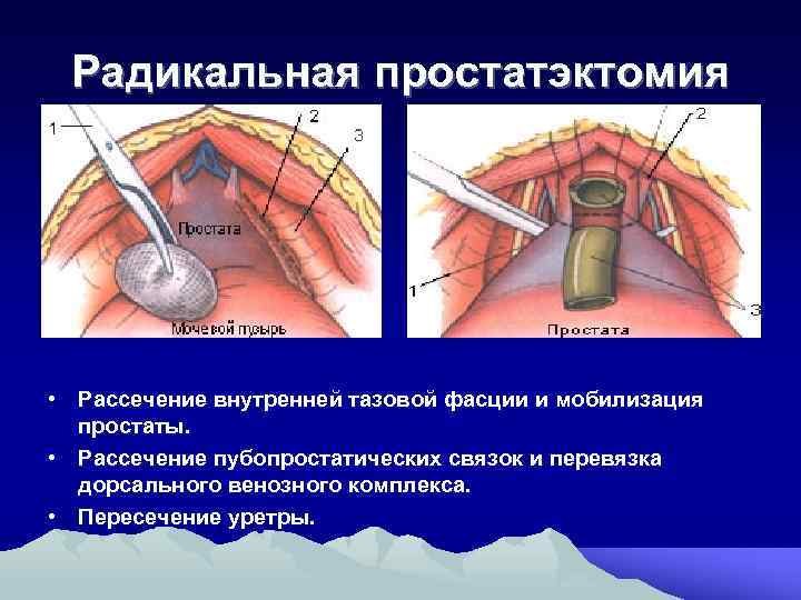 Радикальная простатэктомия • Рассечение внутренней тазовой фасции и мобилизация простаты. • Рассечение пубопростатических связок