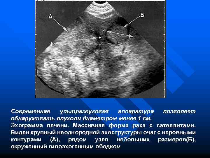 Современная ультразвуковая аппаратура позволяет обнаруживать опухоли диаметром менее 1 см. Эхограмма печени. Массивная форма