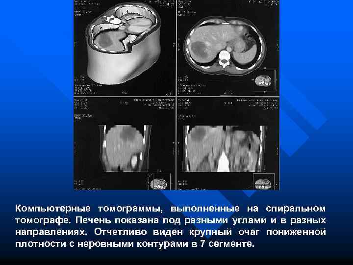 Компьютерные томограммы, выполненные на спиральном томографе. Печень показана под разными углами и в разных