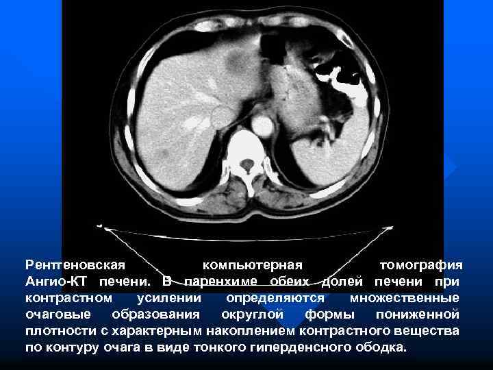 Рентгеновская компьютерная томография Ангио-КТ печени. В паренхиме обеих долей печени при контрастном усилении определяются