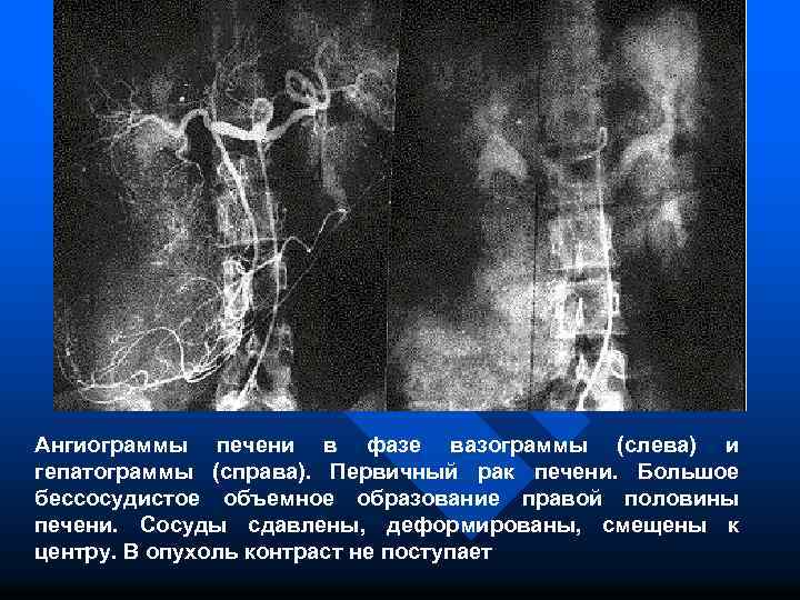 Ангиограммы печени в фазе вазограммы (слева) и гепатограммы (справа). Первичный рак печени. Большое бессосудистое