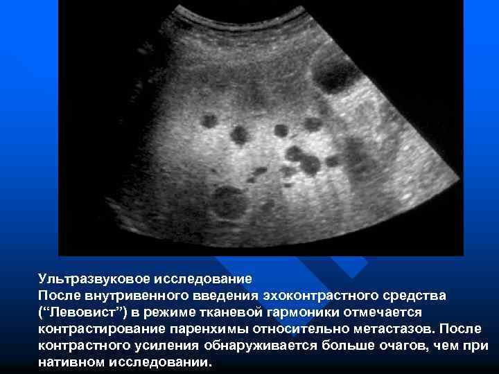 Ультразвуковое исследование После внутривенного введения эхоконтрастного средства (“Левовист”) в режиме тканевой гармоники отмечается контрастирование