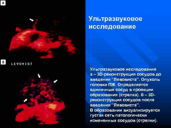 Ультразвуковое исследование а – 3 D-реконструкция сосудов до введения “Левовиста”. Опухоль головки ПЖ. Определяется