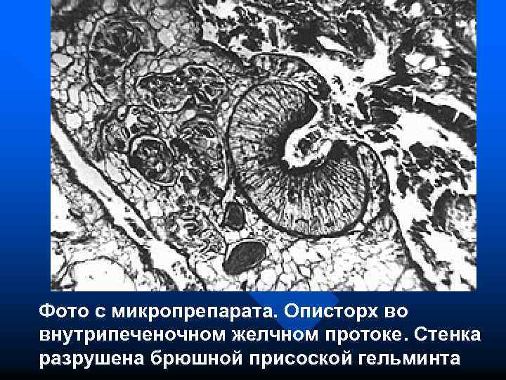 Фото с микропрепарата. Описторх во внутрипеченочном желчном протоке. Стенка разрушена брюшной присоской гельминта 
