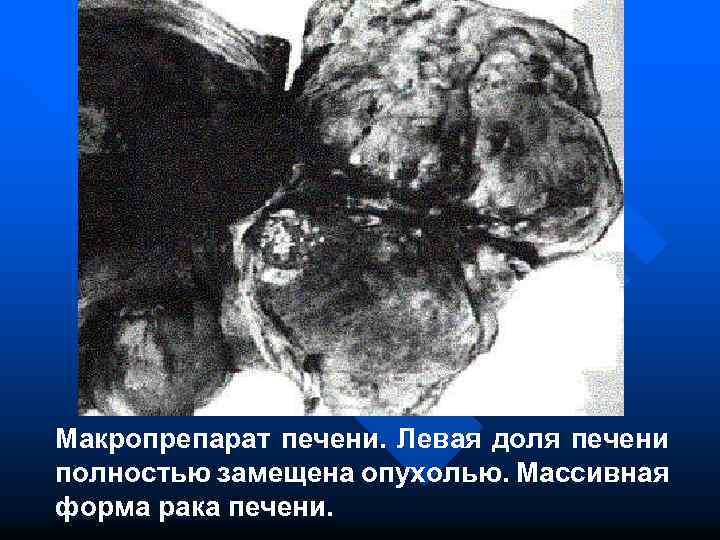 Макропрепарат печени. Левая доля печени полностью замещена опухолью. Массивная форма рака печени. 