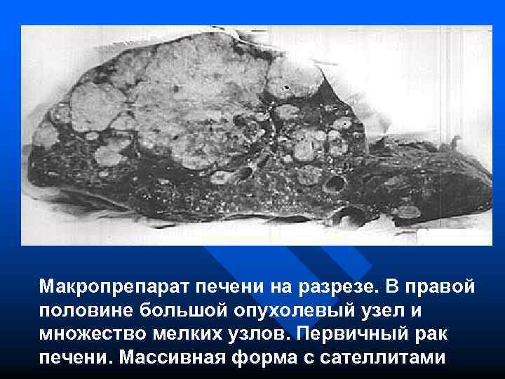 Макропрепарат печени на разрезе. В правой половине большой опухолевый узел и множество мелких узлов.