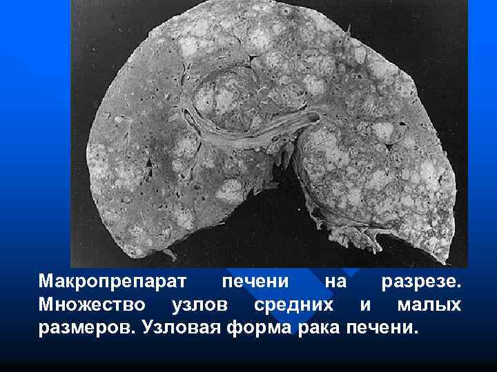 Макропрепарат печени на разрезе. Множество узлов средних и малых размеров. Узловая форма рака печени.