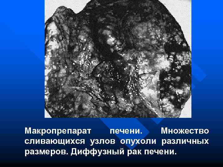 Макропрепарат печени. Множество сливающихся узлов опухоли различных размеров. Диффузный рак печени. 