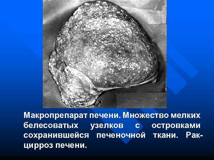 Макропрепарат печени. Множество мелких белесоватых узелков с островками сохранившейся печеночной ткани. Ракцирроз печени. 