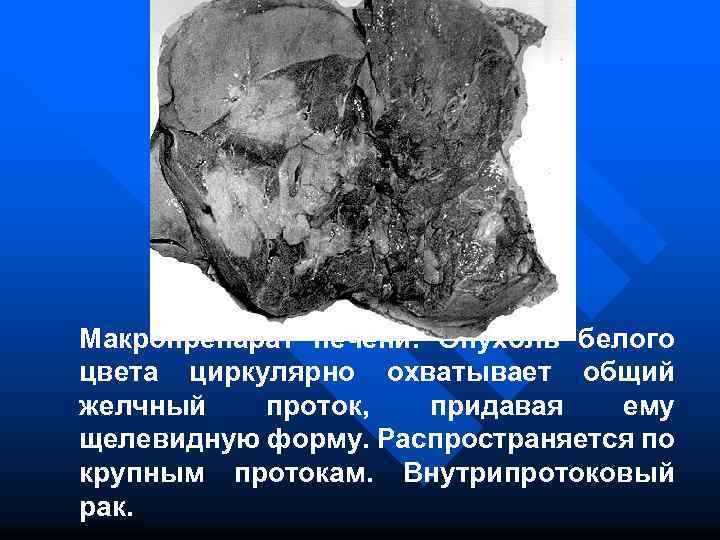 Макропрепарат печени. Опухоль белого цвета циркулярно охватывает общий желчный проток, придавая ему щелевидную форму.