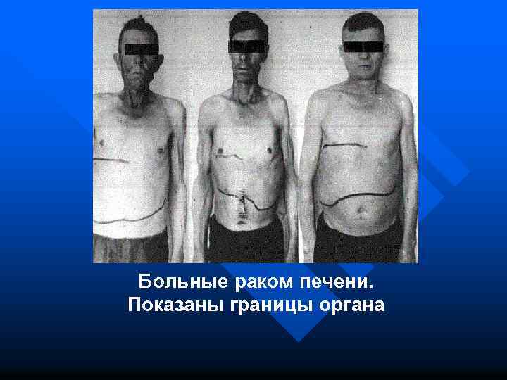 Больные раком печени. Показаны границы органа 