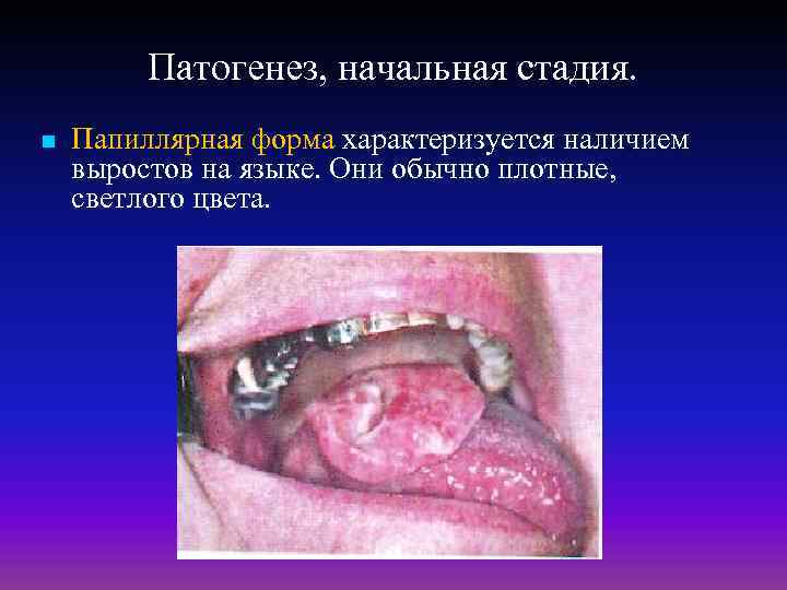 Патогенез, начальная стадия. n Папиллярная форма характеризуется наличием выростов на языке. Они обычно плотные,
