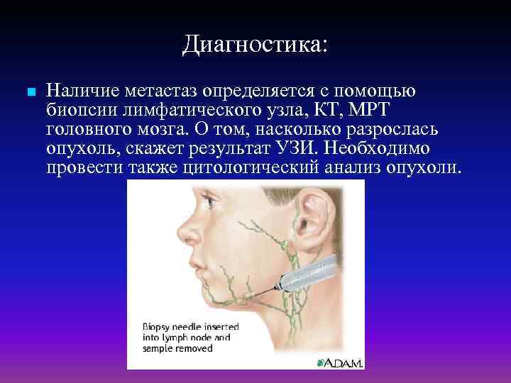 Диагностика: n Наличие метастаз определяется с помощью биопсии лимфатического узла, КТ, МРТ головного мозга.
