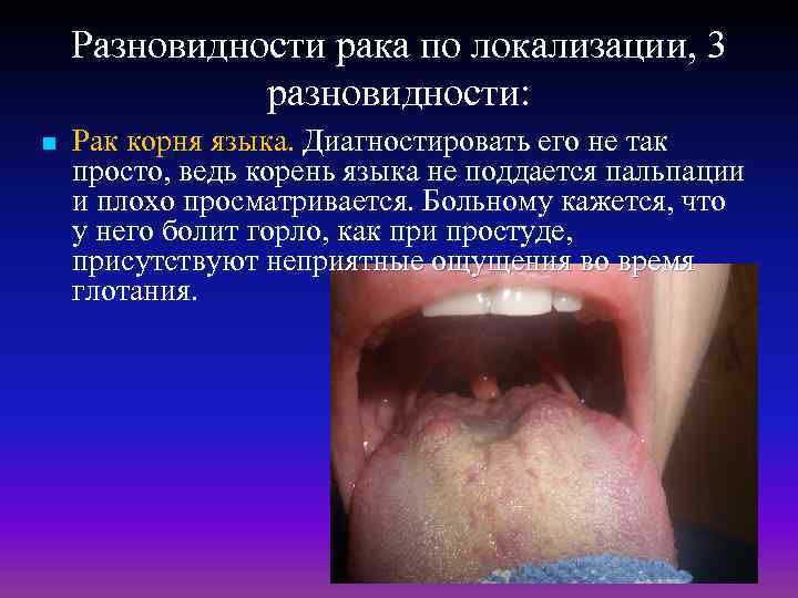 Разновидности рака по локализации, 3 разновидности: n Рак корня языка. Диагностировать его не так