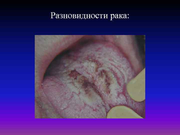 Разновидности рака: 