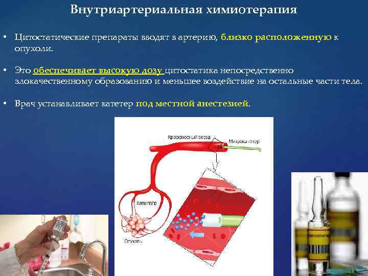 Внутриартериальная химиотерапия • Цитостатические препараты вводят в артерию, близко расположенную к опухоли. • Это