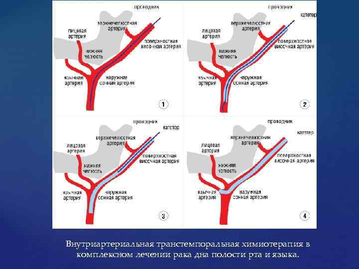 Внутриартериальная транстемпоральная химиотерапия в комплексном лечении рака дна полости рта и языка. 