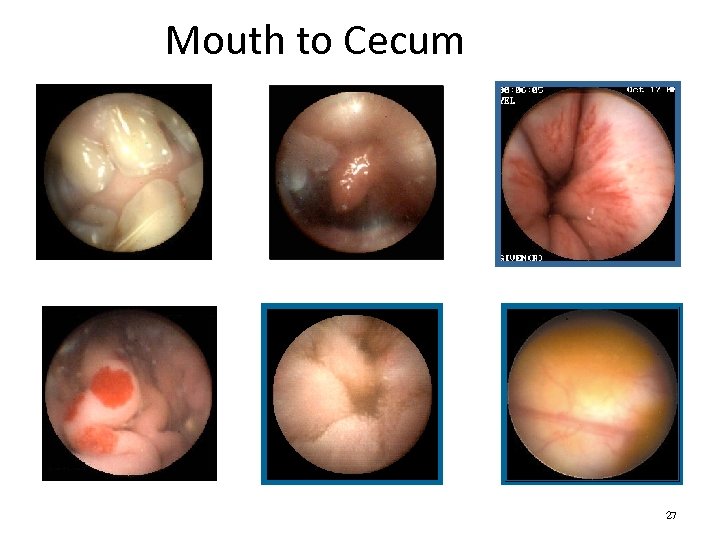 Mouth to Cecum Teeth Multiple telangiectasia on a gastric fold Epiglottis Small Intestine Barret’s