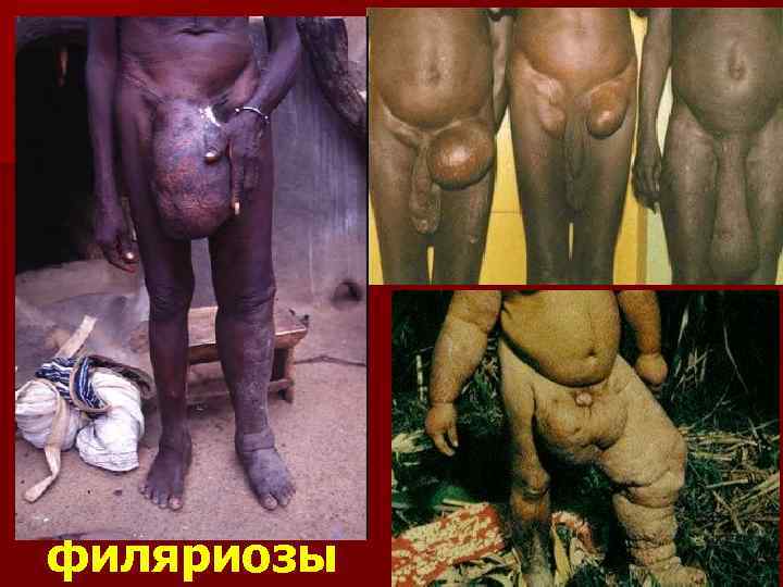 филяриозы 