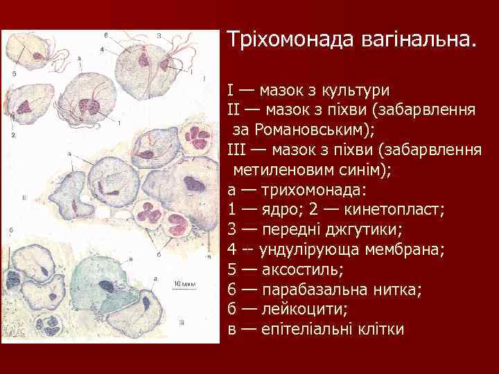 Тріхомонада вагінальна. I — мазок з культури II — мазок з піхви (забарвлення за