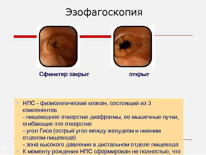 Эзофагоскопия Сфинктер закрыт 15 открыт • НПС - физиологический клапан, состоящий из 3 компонентов