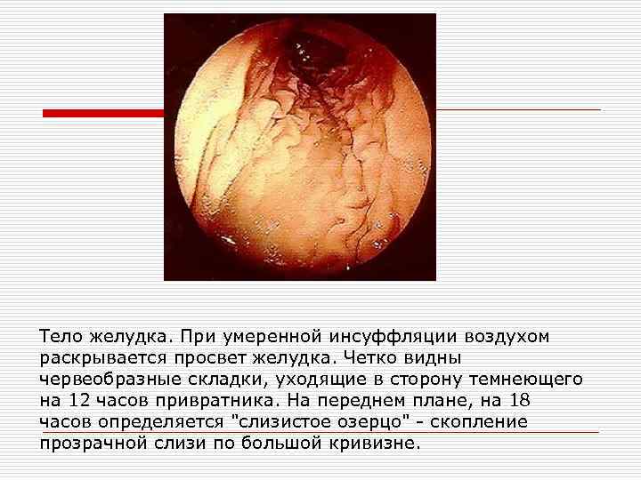 Тело желудка. При умеренной инсуффляции воздухом раскрывается просвет желудка. Четко видны червеобразные складки, уходящие