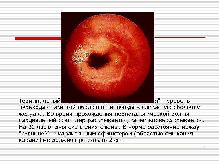 Терминальный отдел пищевода. Видна "Z-линия" - уровень перехода слизистой оболочки пищевода в слизистую оболочку