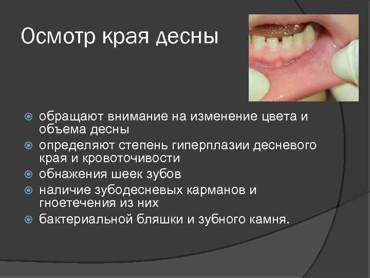 Осмотр края десны обращают внимание на изменение цвета и объема десны определяют степень гиперплазии