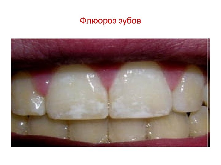 Флюороз зубов 