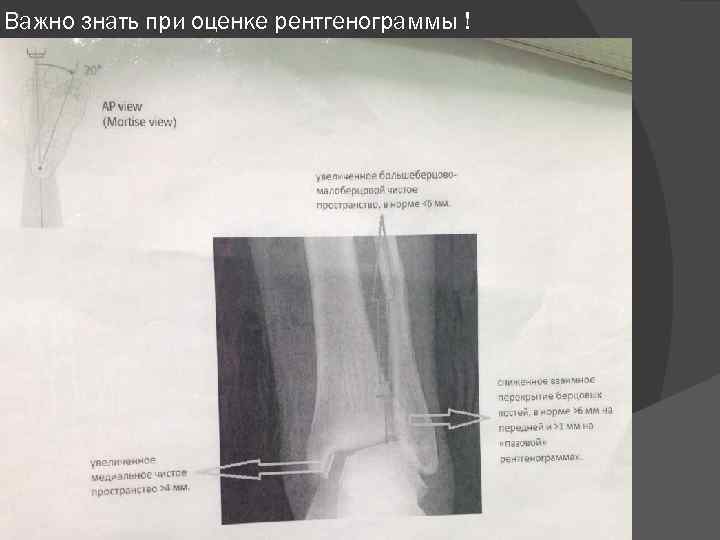 Важно знать при оценке рентгенограммы ! 