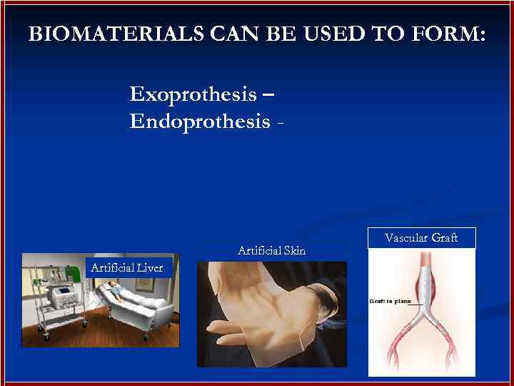 BIOMATERIALS CAN BE USED TO FORM: Exoprothesis – Endoprothesis - Artificial Skin Artificial Liver